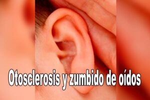 Otosclerosis y zumbido de oídos