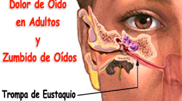 Dolor de oído en adultos - Zumbido de oídos